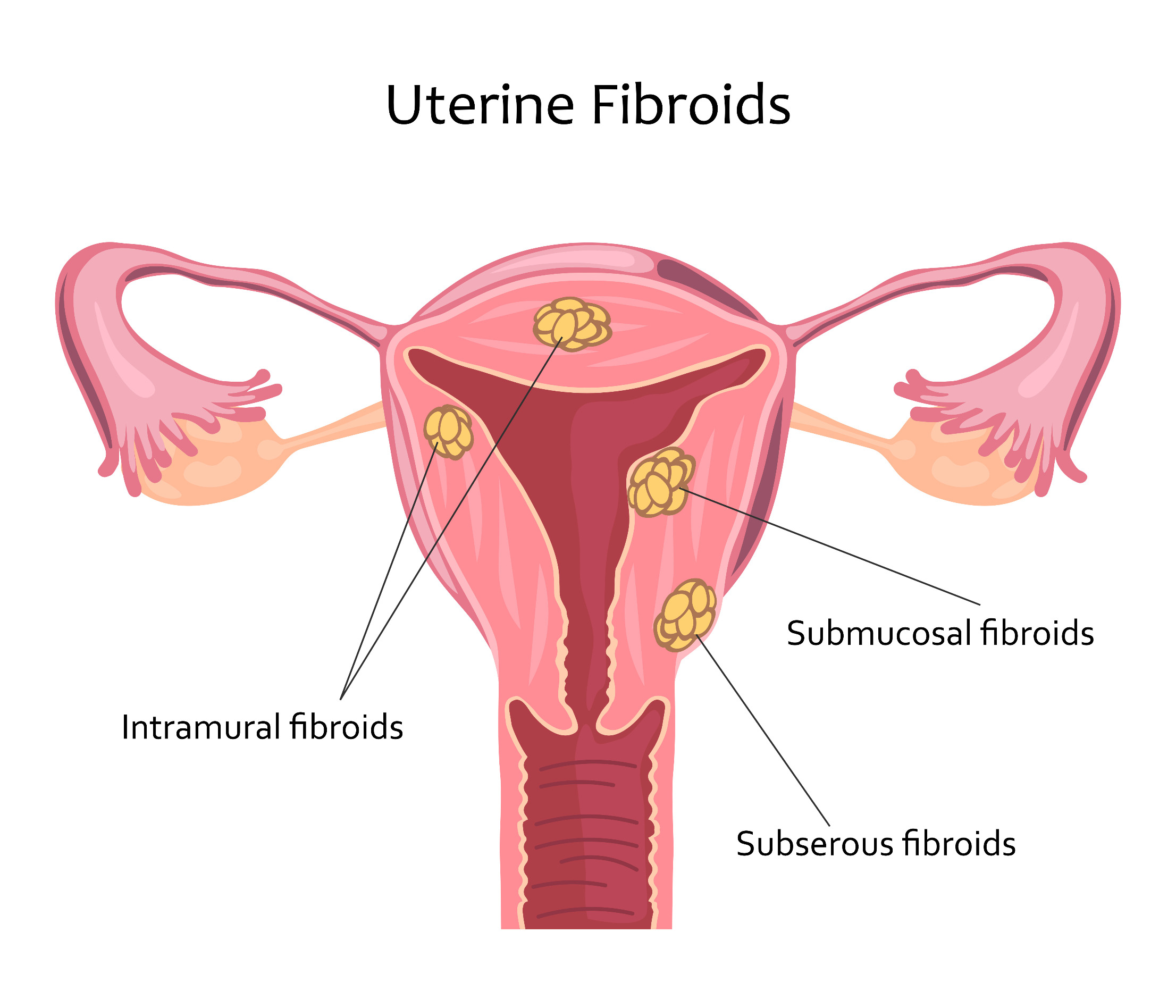 uterine fibroid embolization Indiana